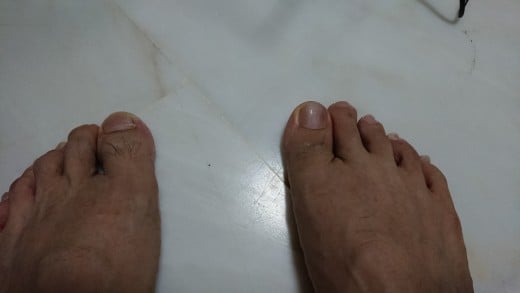 I cannot bend my right big toe first knuckle, unlike my left