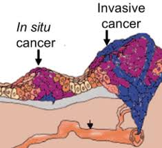 My cancer was In Situ.