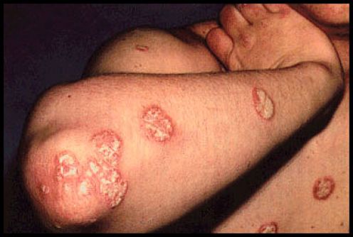 Plaque Psoriasis Elbow