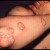Plaque Psoriasis Elbow Plaque Psoriasis Elbow