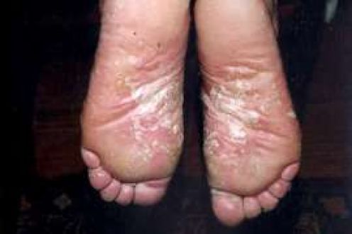 Psoriasis Feet