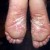 Psoriasis Feet Psoriasis Feet