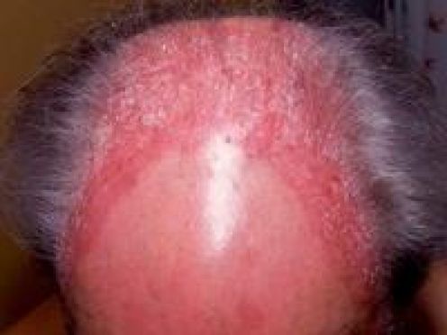 Psoriasis Scalp