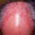 Psoriasis Scalp Psoriasis Scalp