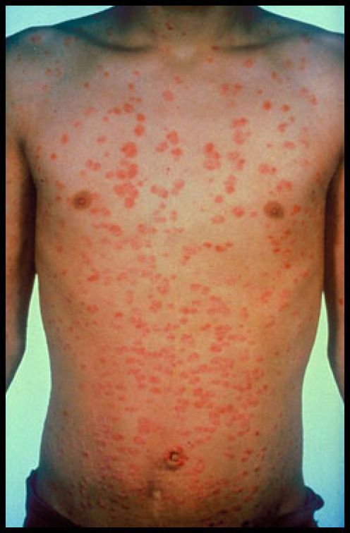 Guttate Psoriasis