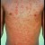 Guttate Psoriasis Guttate Psoriasis