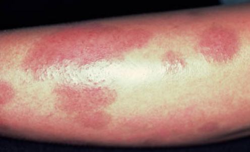 Pustular Psoriasis