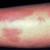 Pustular Psoriasis Pustular Psoriasis
