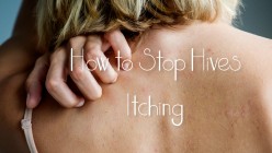 Urticaria, How to Treat Itching From Hives