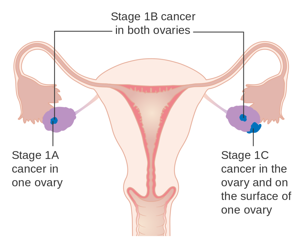 Key Information About Ovarian Cancer