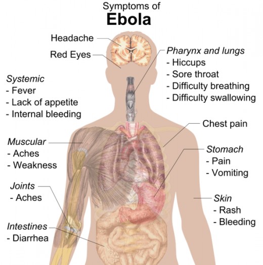 Signs and symptoms of ebola virus disease.