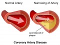 Key Information About Coronary Artery Disease