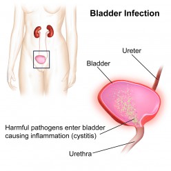 Key Information About Urinary Tract Infection