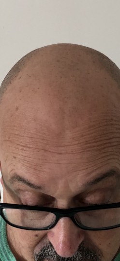 Baldness Solution- Smp, in My Experience. Pub-4684700343977382