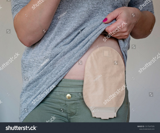 Colostomy bag after fixing