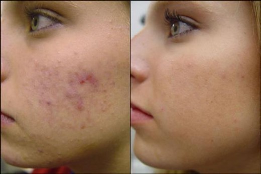 A solution of 3% Hydrogen peroxide is a Home Remedy which is a Miracle Acne Cure 