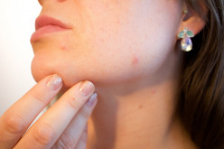 Acne: Managing It At Adolescence or Adulthood