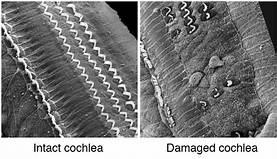 You can see the difference between normal hair cells in the cochlea and damaged hair cells here.