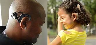 Cochlear Implant on an adult and a child