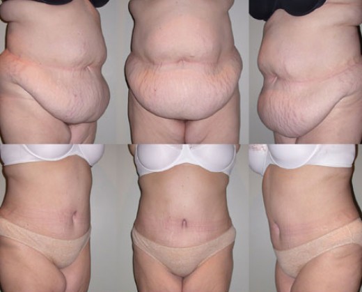 tummy tuck cost