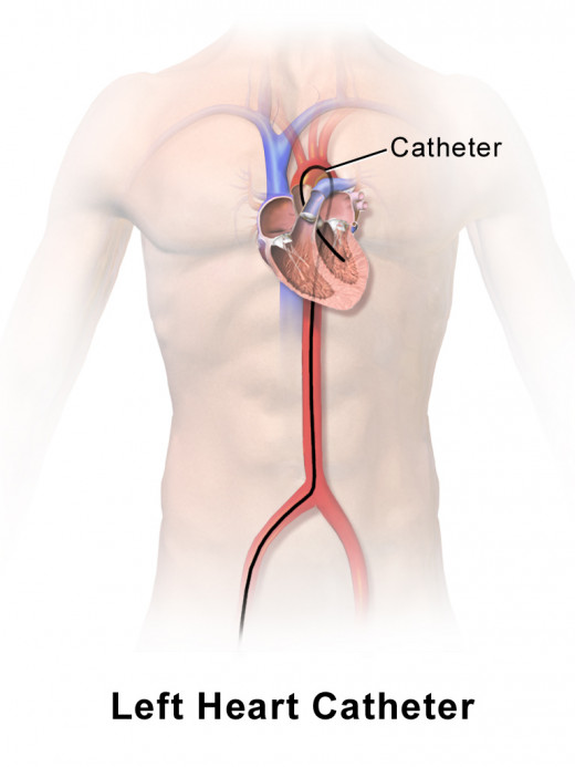 Left heart catheterization