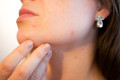 Acne Dos and Don’ts