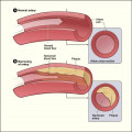 Key Information About Atherosclerosis