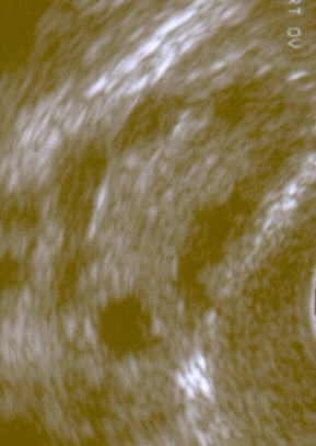 Ultrasoun showing cysts