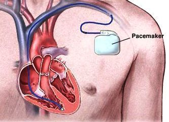 cardiac pacemakers
