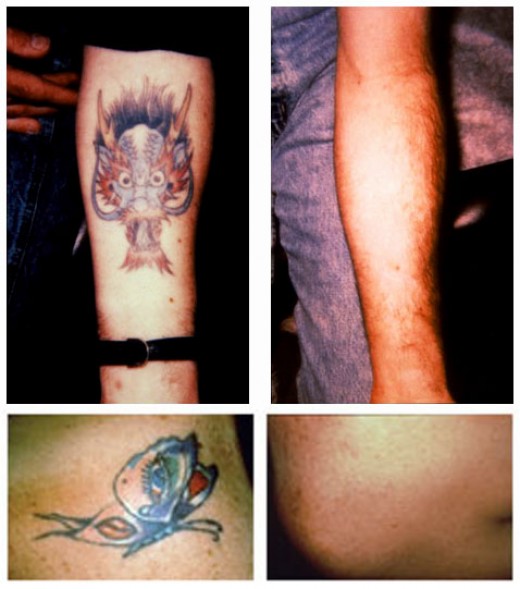 wrecking ball tattoo removal cream wrecking balm tattoo removal system.