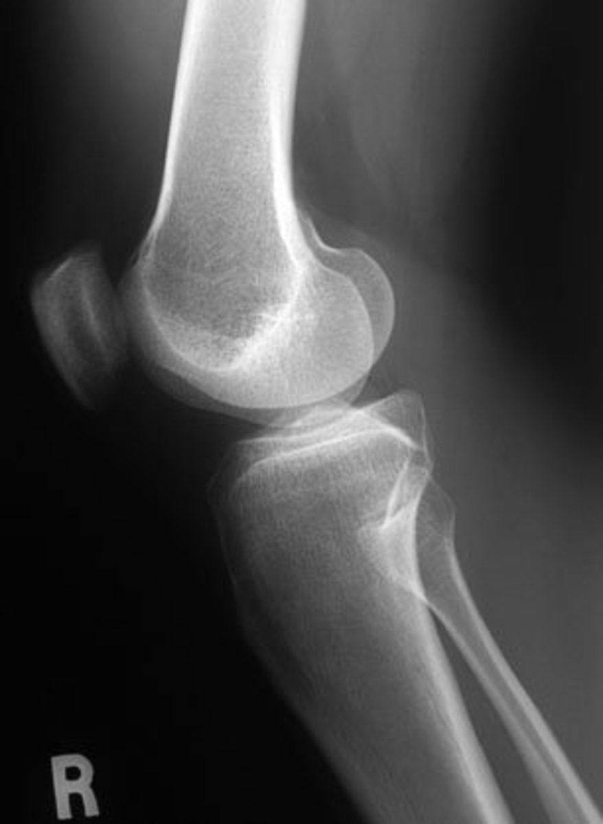 Three Different Types of Knee X-Rays With Photos | HealDove