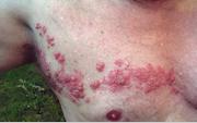 Zoster (shingles) on the chest--Image courtesy of Wikipedia