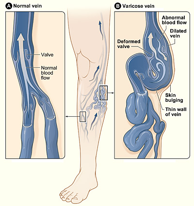 Varicose veins anatomy