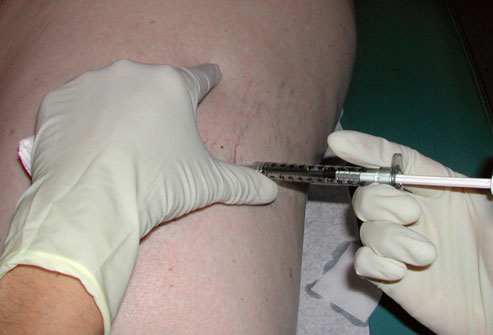 Vericose veins injections