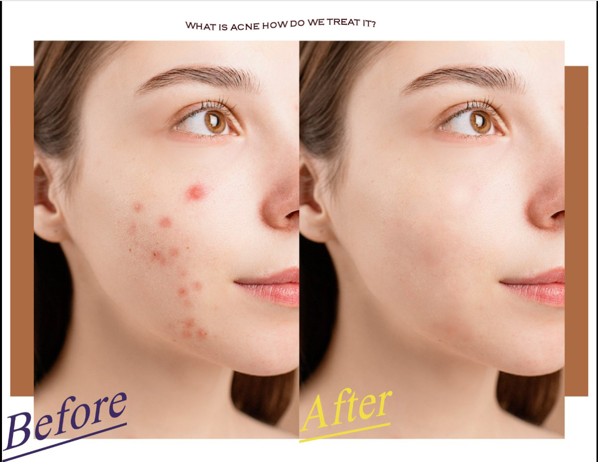 What Is Acne and How Do We Treat It?
