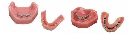 Dentures - Dental Implants