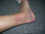 Symptoms of sprain include swelling, discoloration and pain