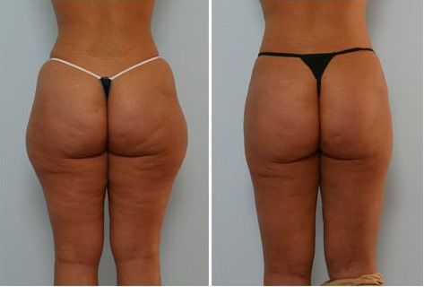Liposuction of hips before and after the procedure is done.