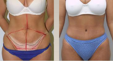 Tummy plastic surgery also known as abdominoplasty