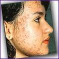 Image courtesy of Google Images by way of acnemedicationtreatments.com