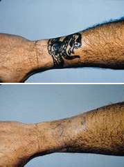 After 5 Treatments