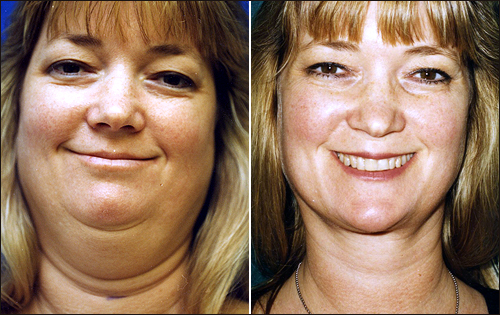 Successful face/chin liposuction. [plasticsurgery1.com]