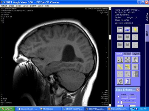 side view of the intraventricular brain cyst.  Looks like a black egg...