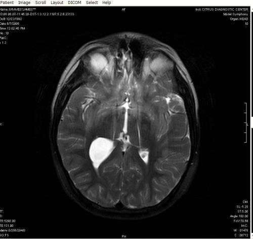 Detailed view of Jimmy's cyst from the top of the head.  