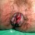 Abnormal rectal bleeding may be fatal Abnormal rectal bleeding may be fatal