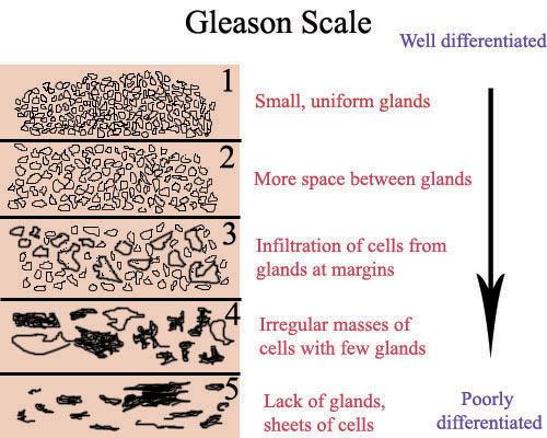 Fig. 7: Chart describes the type of cancer usually associated with each grade of cancer. A lower Gleason grade indicates a well differentiated cancer, or a lower potential to spread. A higher Gleason grade indicates a poorly differentiated cancer.