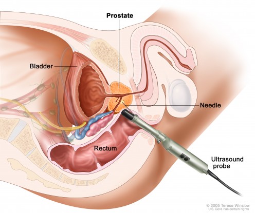 Fig. 6: Biopsy of Prostate. Transperineal biopsy: The removal of tissue from the prostate by inserting a thin needle through the skin between the scrotum and rectum and into the prostate. A pathologist views the tissue under a microscope to look for 