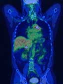 Image obtained from combination of PET and CT technology  Source: Radiologyinfo.org