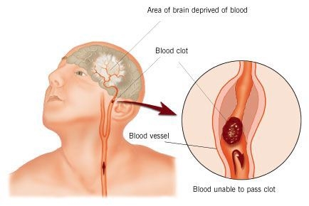 Stroke Symptoms