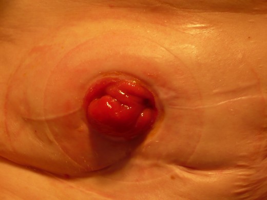 This is a stoma, which is red and moist. A stoma has no nerve endings and therefore no sensation. A bag is placed over the stoma to allow the contents of bowel to empty into it.